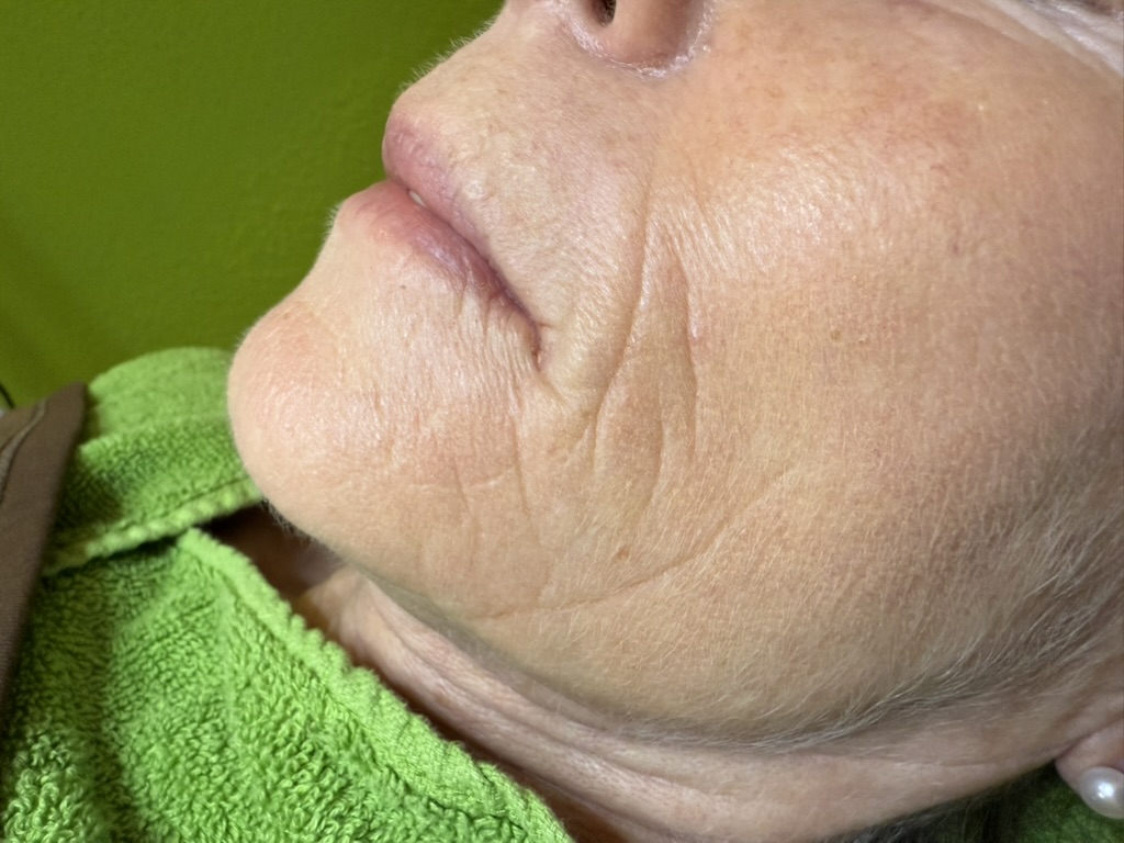 Bild 1 – Anti-Aging Booster - Micro- und NanoNeedling Gesichtsbehandlung