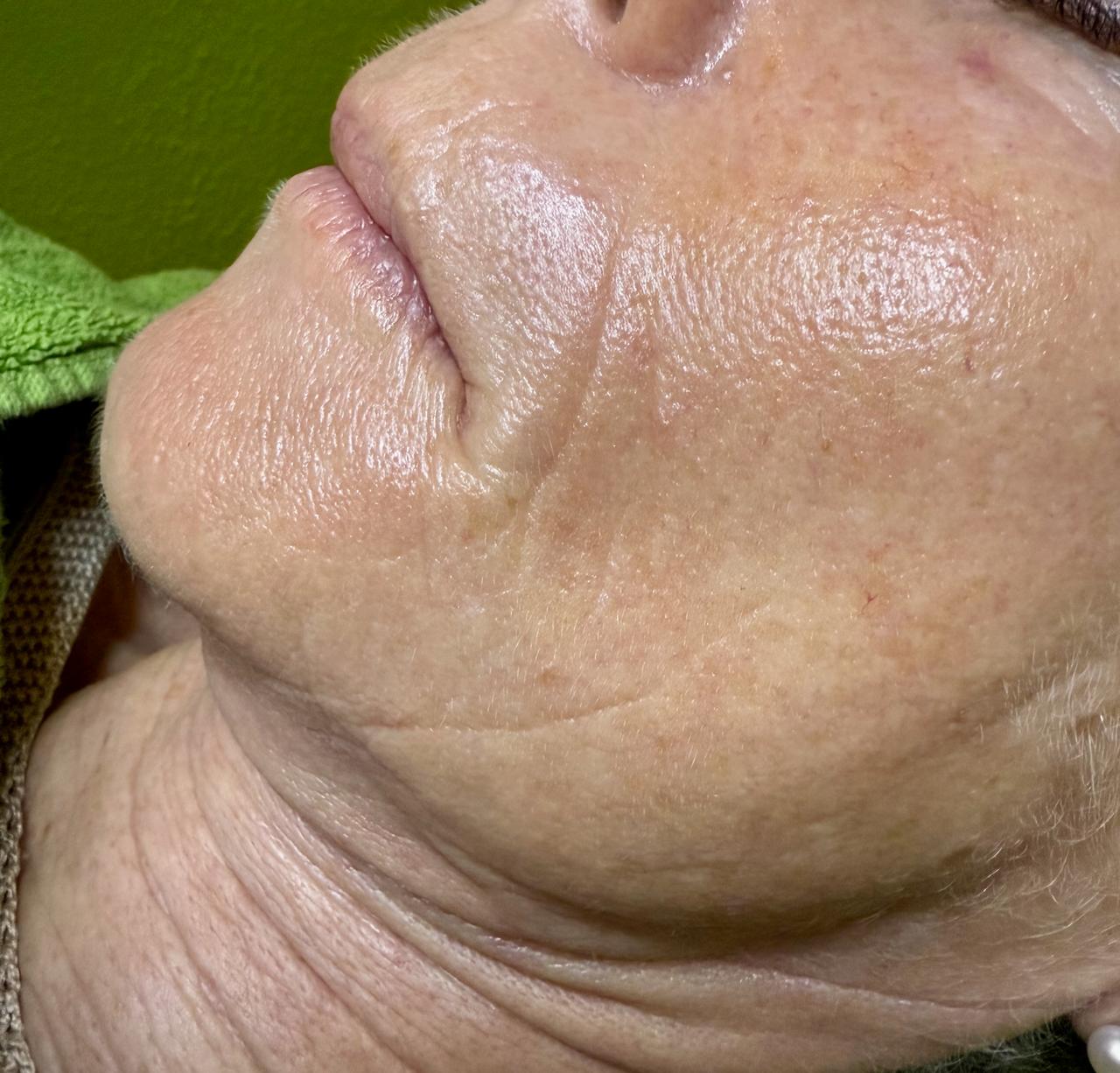 Bild 2 – Anti-Aging Booster - Micro- und NanoNeedling Gesichtsbehandlung